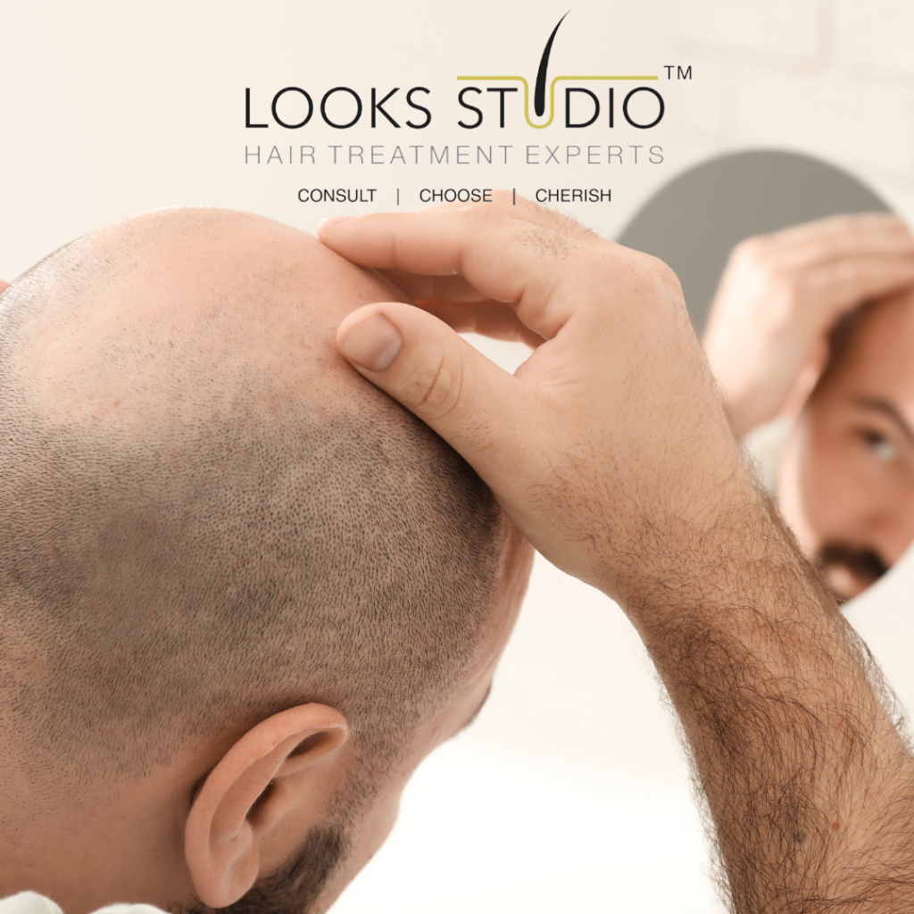 Hair Transplant In Chennai