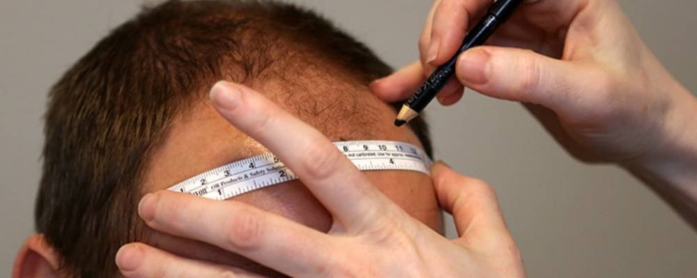 Best Hair Transplant in Pune