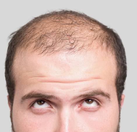 Give your “turf” a chance!! Hair Transplant Looks Studio