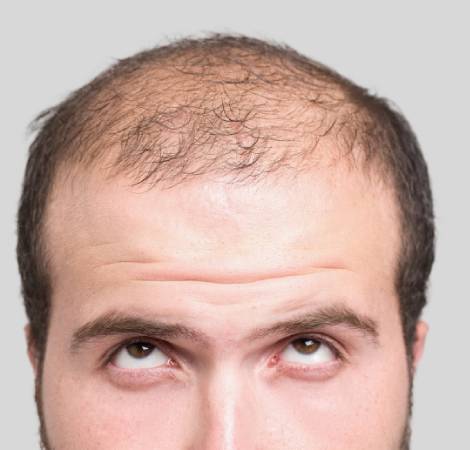 Hair Transplant age limit hair transplant minimum age best age for hair  transplant