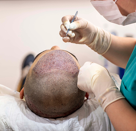 Proven shot at reviving your lost hair: Hair Transplant