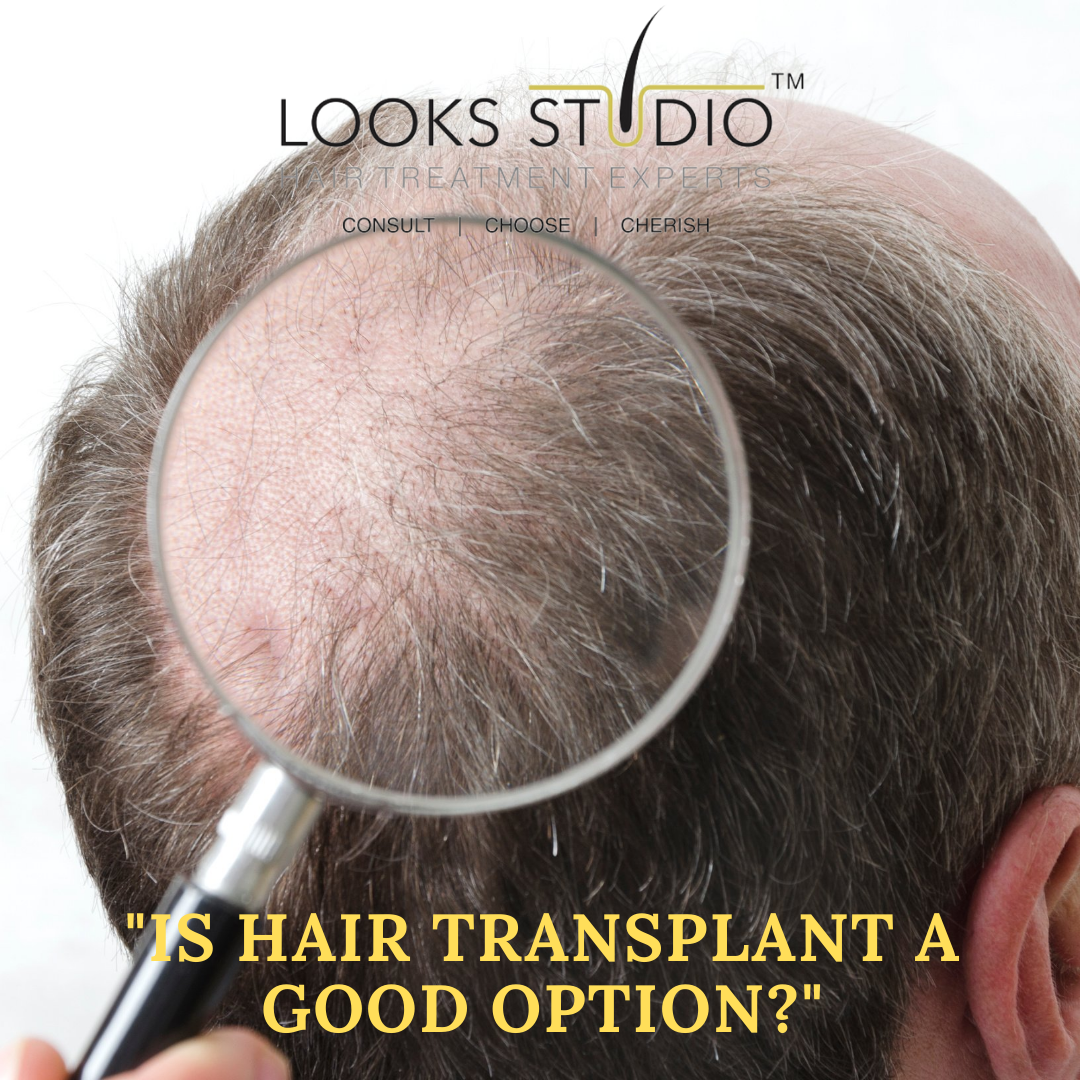 IS HAIR TRANSPLANT A GOOD OPTION?