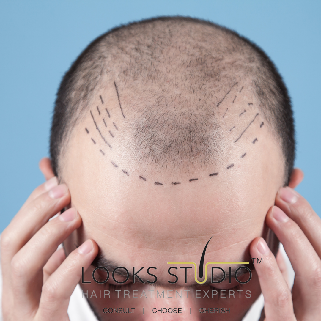 Is Hair Transplant Worth It?: Guide From Looks Studio (2022)