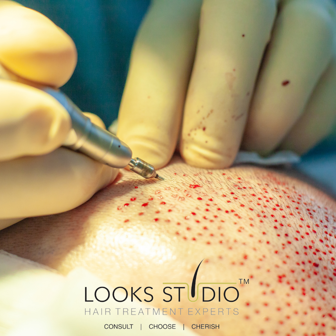 DOES THE HAIR TRANSPLANT PROCEDURE HURT? : Guide From Looks Studio(2022)