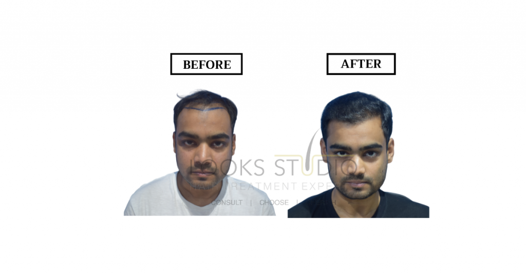 ARE HAIR TRANSPLANTS RELIABLE? : The Definitive Guide(2023)- Looks Studio?  - Hair Transplant | Looksstudio | Blog