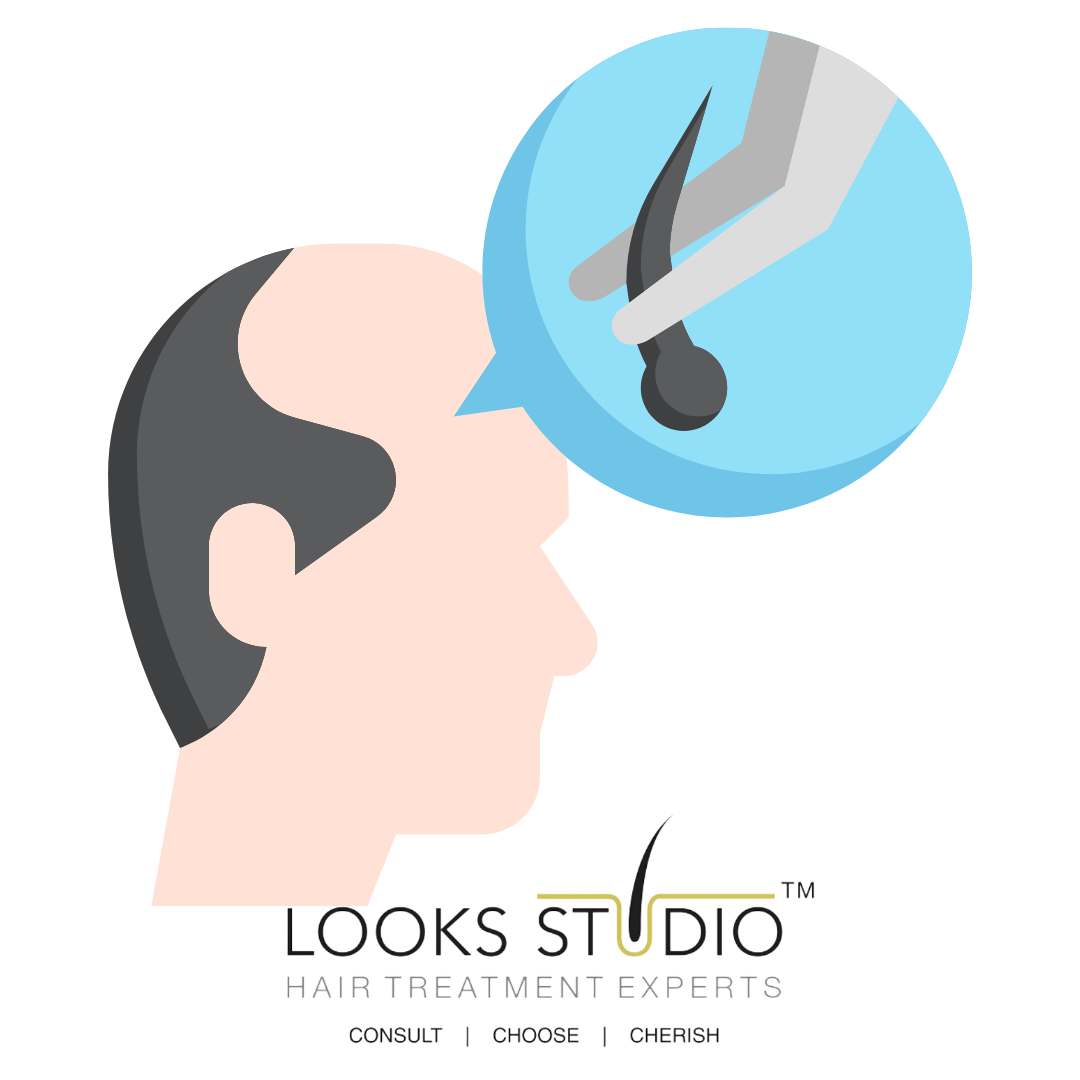 BEST AGE FOR A HAIR TRANSPLANT? : Guide-Looks Studio(2022)