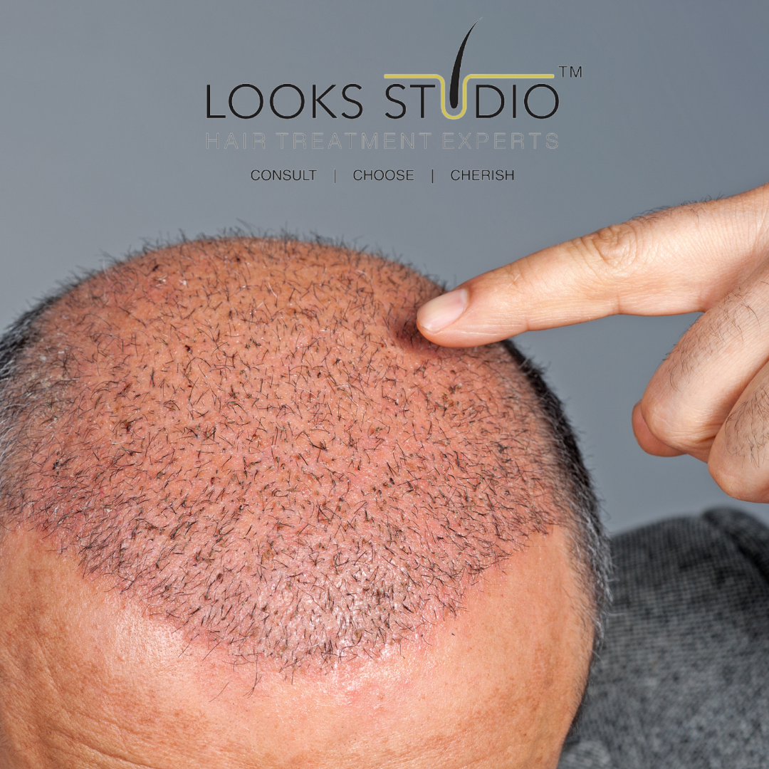 ARE HAIR TRANSPLANTS RELIABLE? : The Definitive Guide(2023)- Looks Studio?