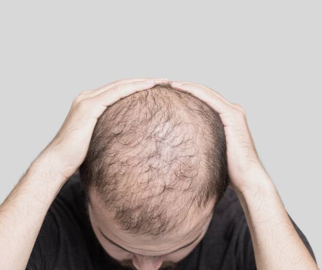 How does testosterone relate to hair loss - Looks Studio Hair Transplant