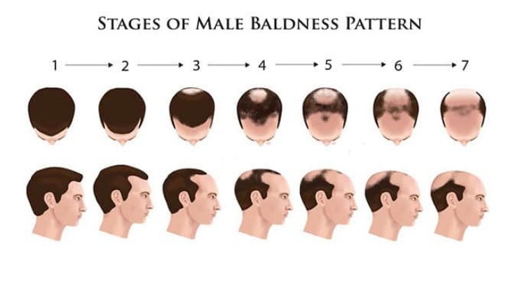 Male Pattern Baldness