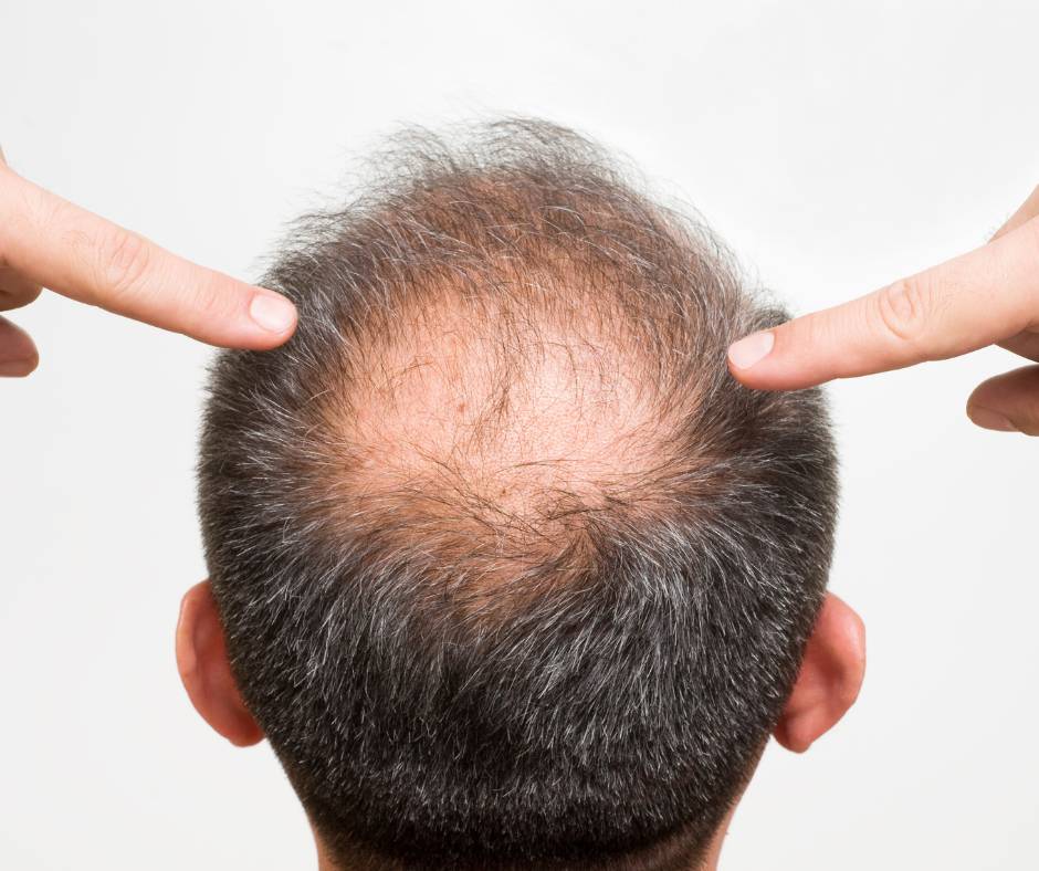 How does Testosterone relate to Hair Loss?