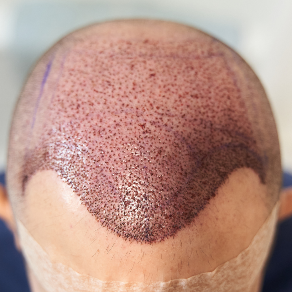 Hair regrowth after a Hair transplant