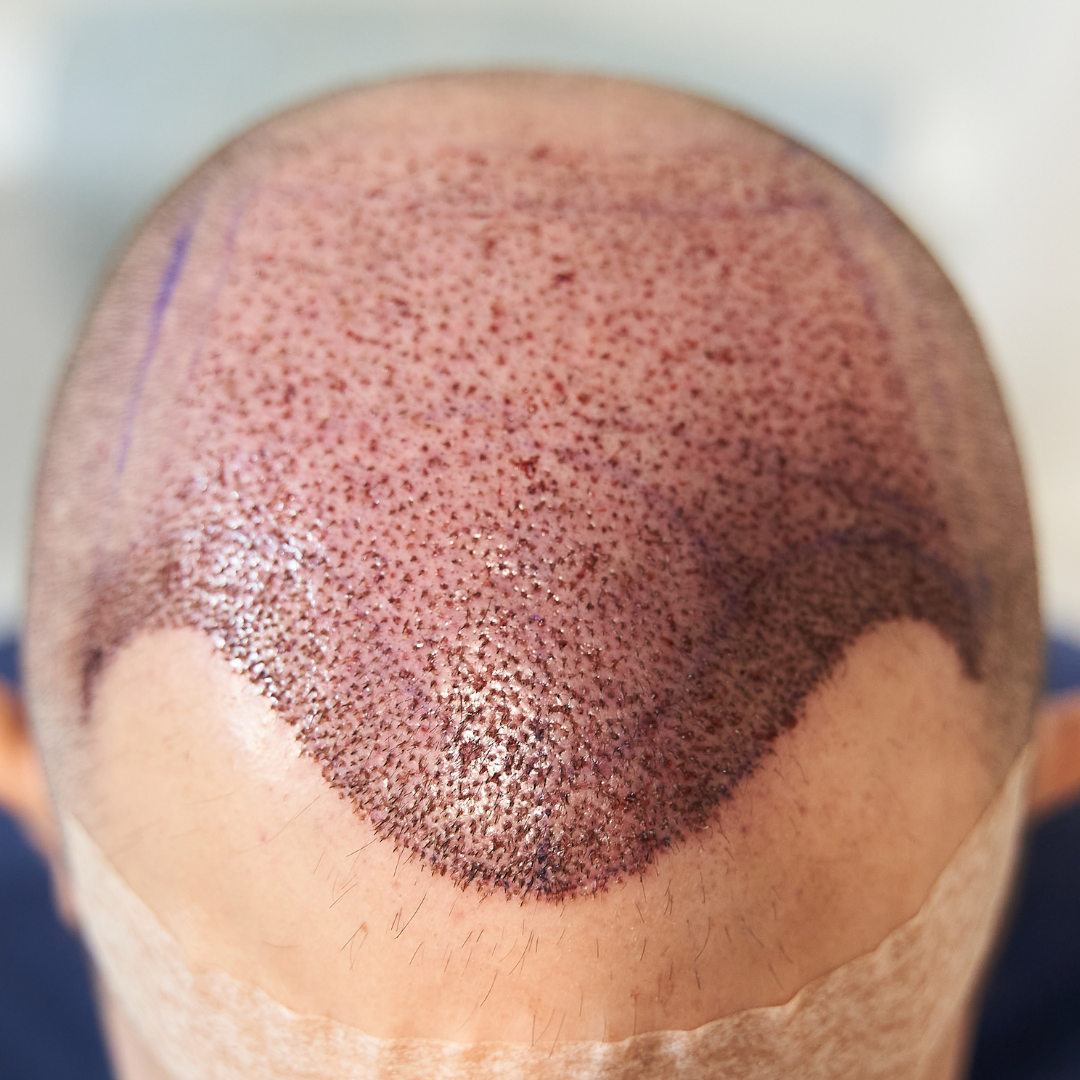 A complete guide for hair re-growth after a Hair transplant?