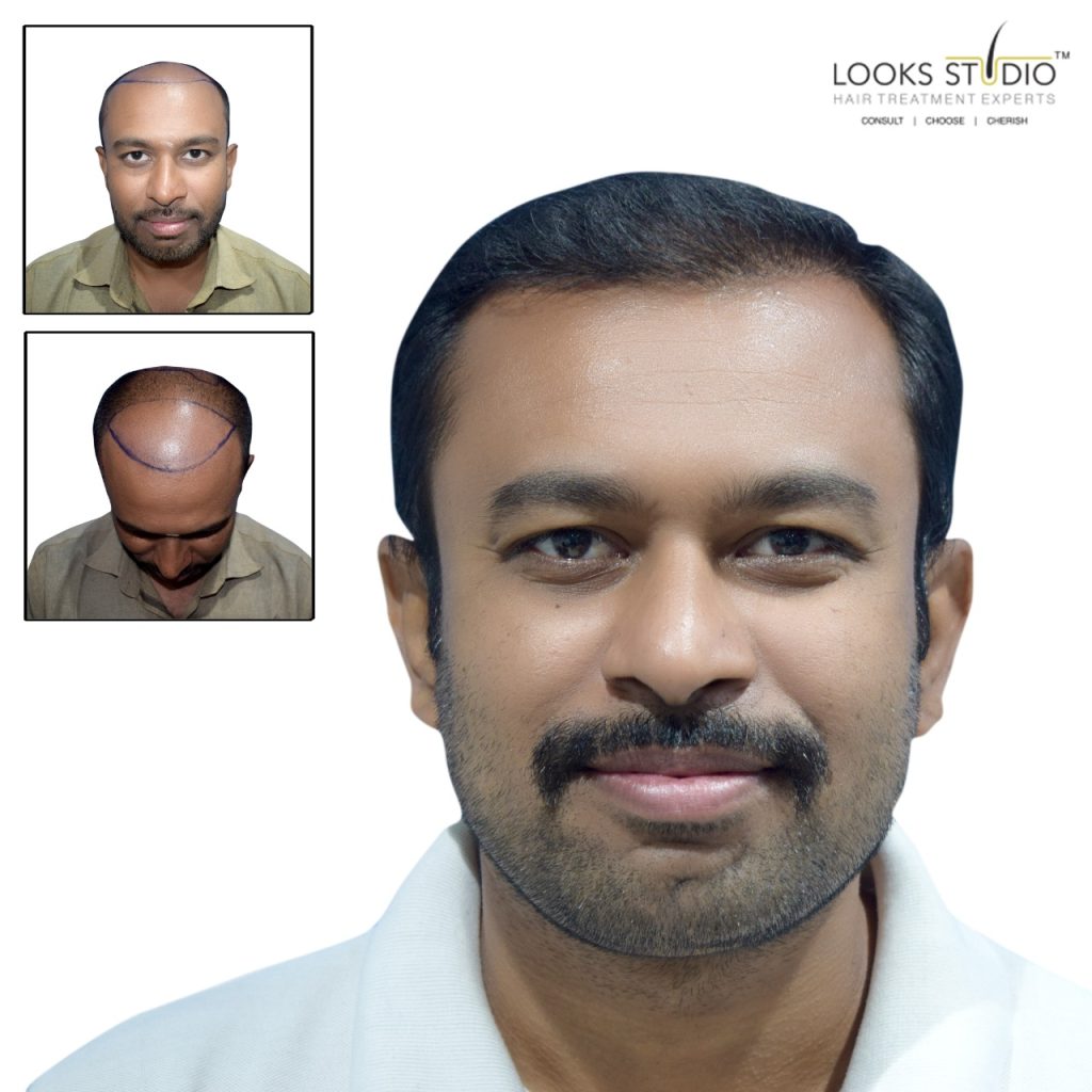 Hair Transplant in Ahmedabad - Hair Transplant | Looksstudio | Blog