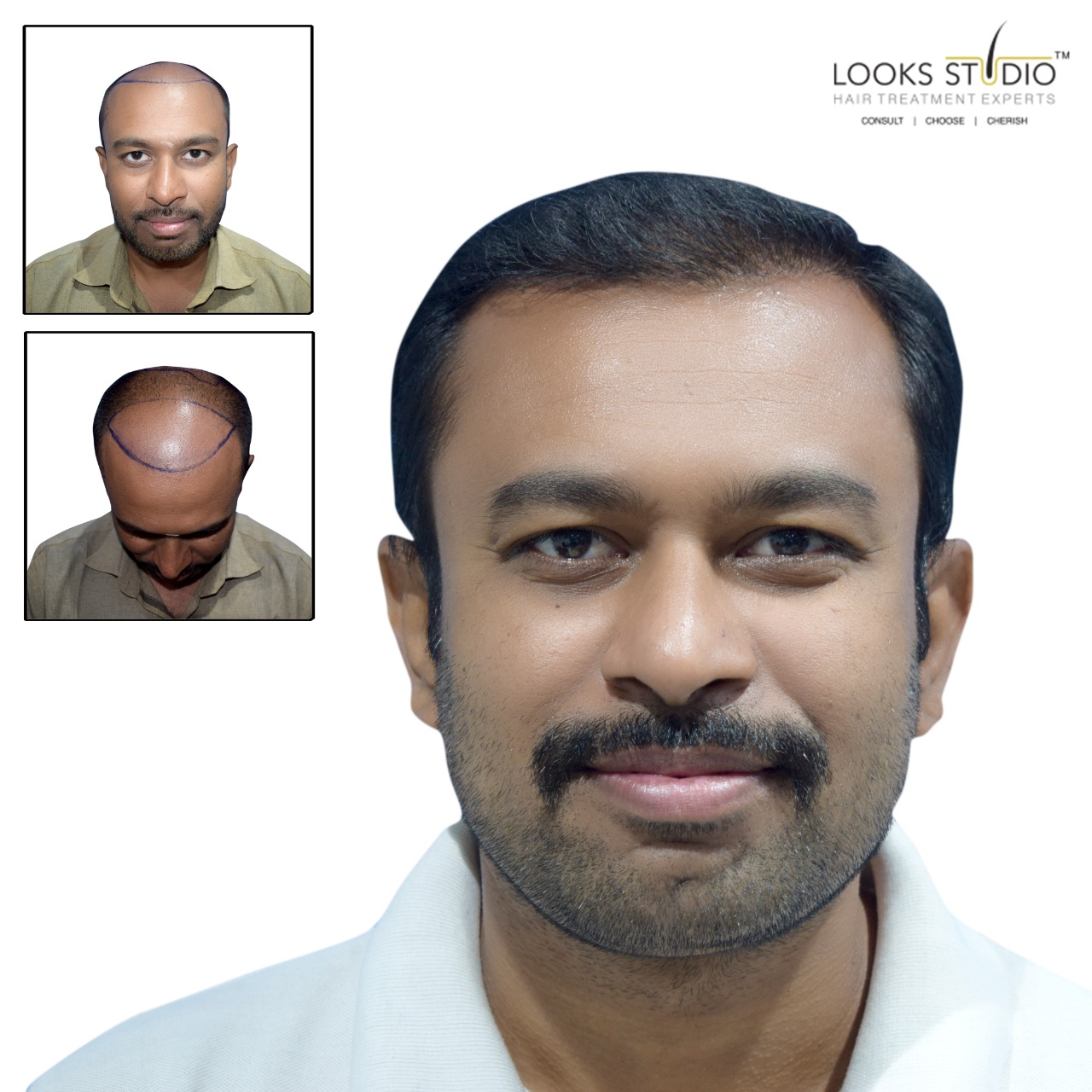 Hair Transplant in Bangalore: Looks Studio