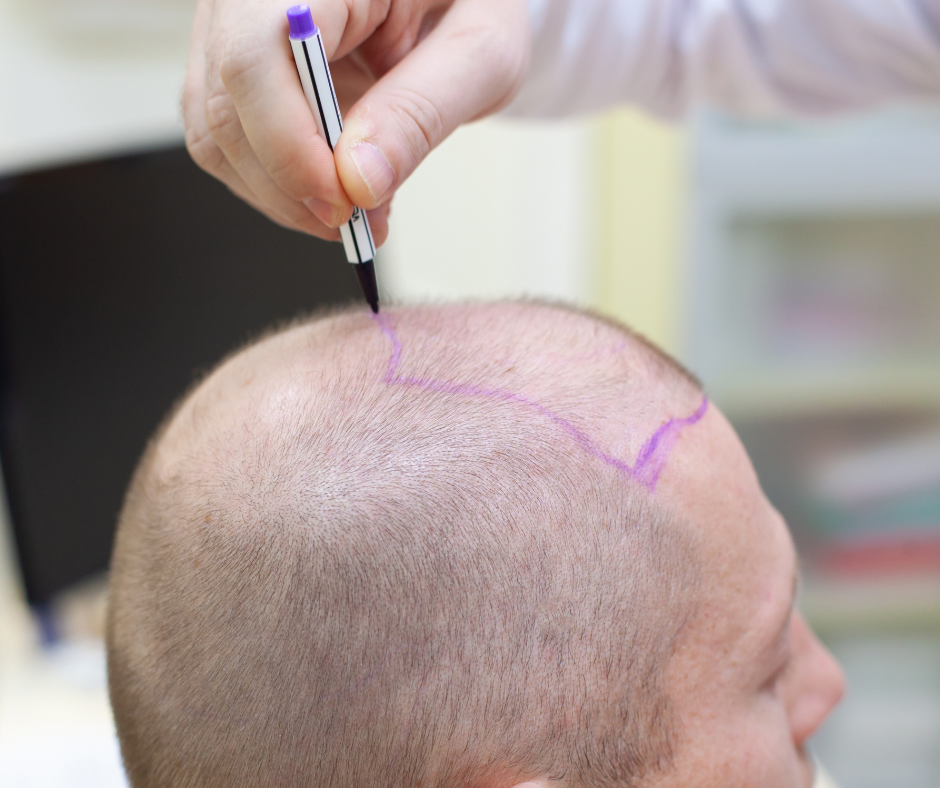 Why Hair Transplant Better Than Wigs or Lace System
