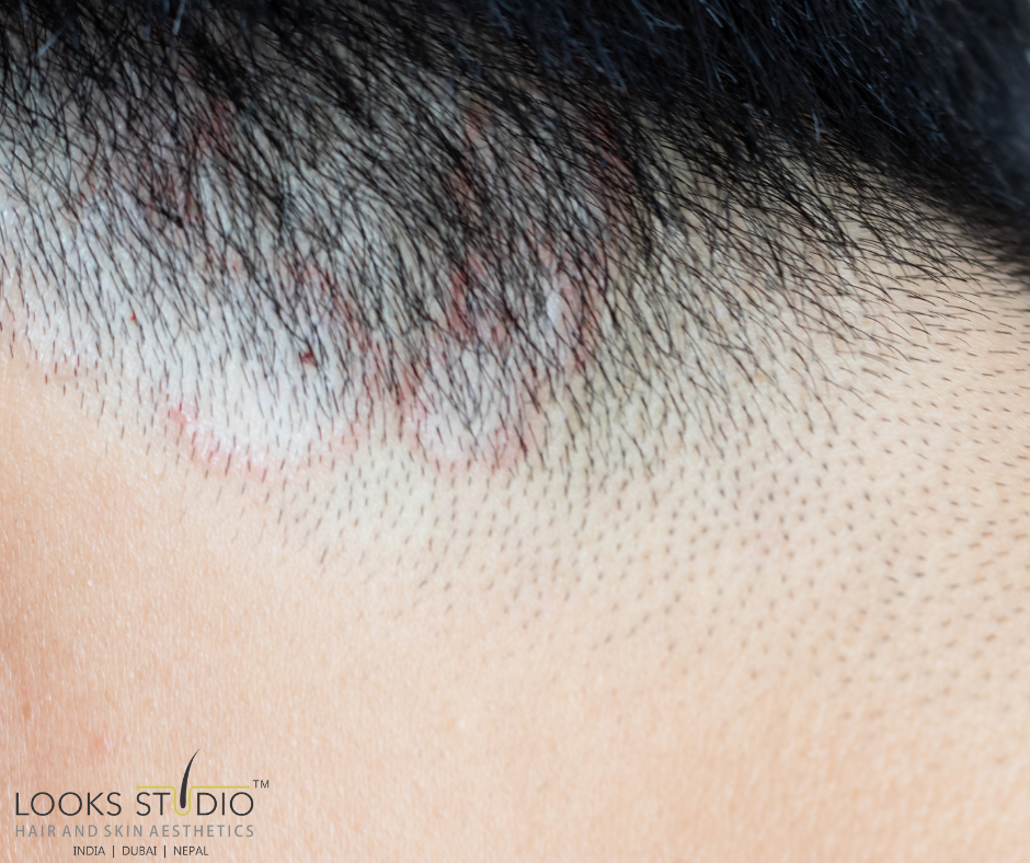 Don't let Tinea Capitis steal your hair! - Hair Transplant