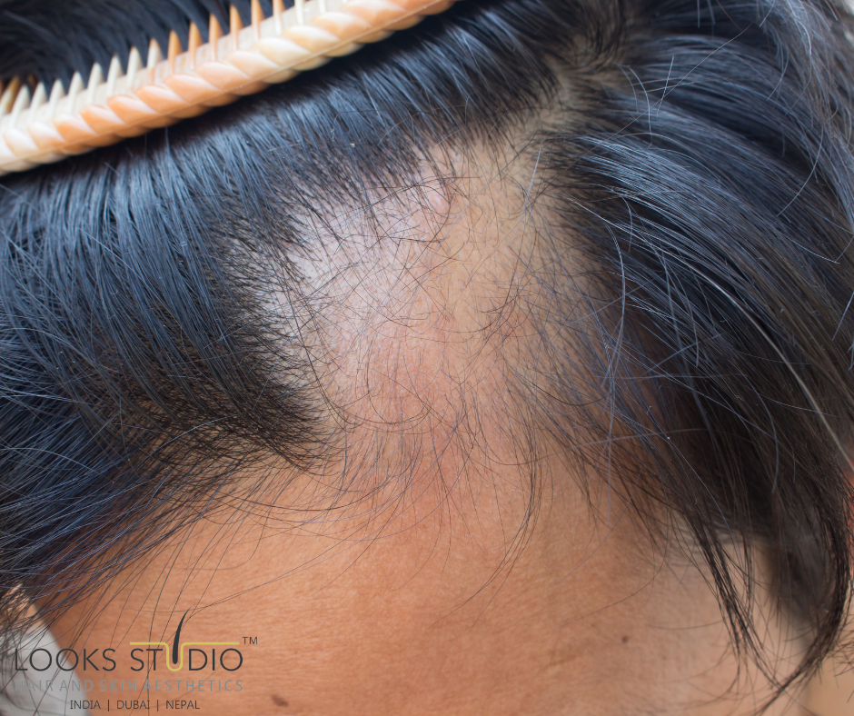 Don't let Tinea Capitis steal your hair! - Hair Transplant