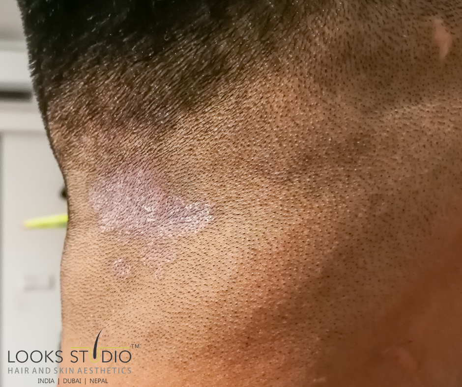 Hair loss due Tinea Capitis