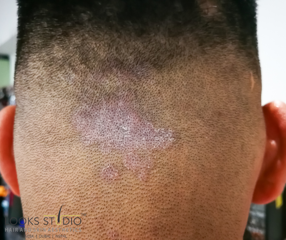 Don’t let Tinea Capitis steal your hair!