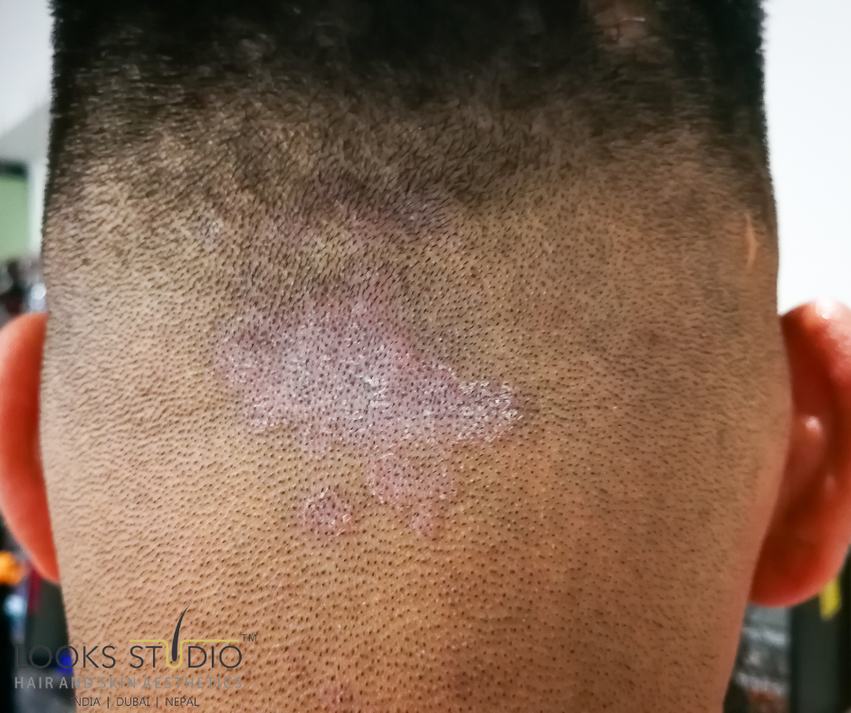 Don't let Tinea Capitis steal your hair! - Hair Transplant