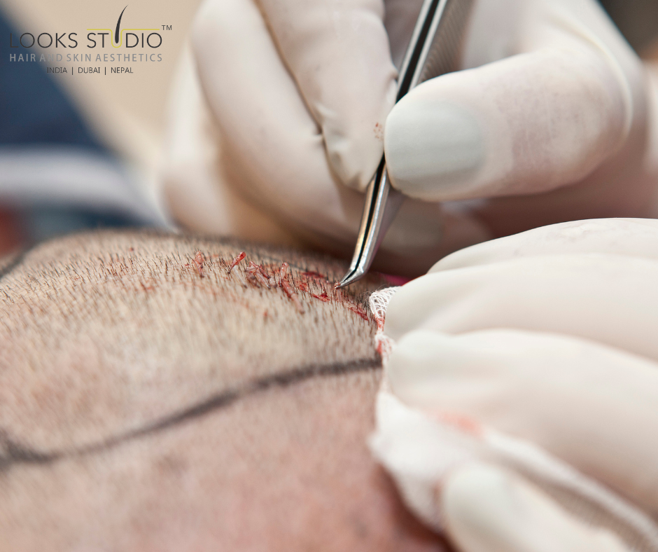 The Truth About Hair Transplant Pain: What to Expect During the Procedure