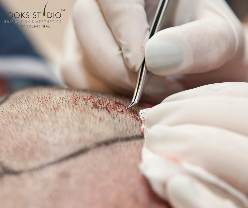  Hair Transplant Pain