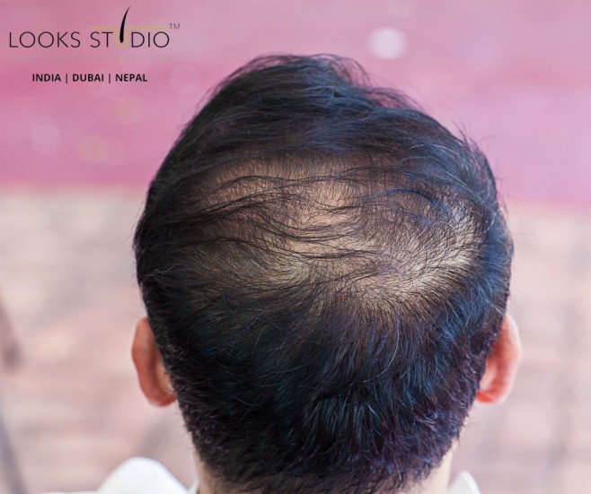 Hair Fall In Post Pregnancy & its solutions - Hair Transplant, Looksstudio