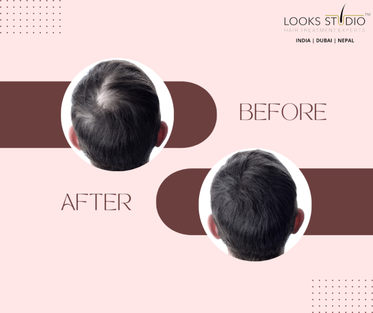 achieve-gorgeous-hair-with-gfc-hair-treatment-a-comprehensive-guide