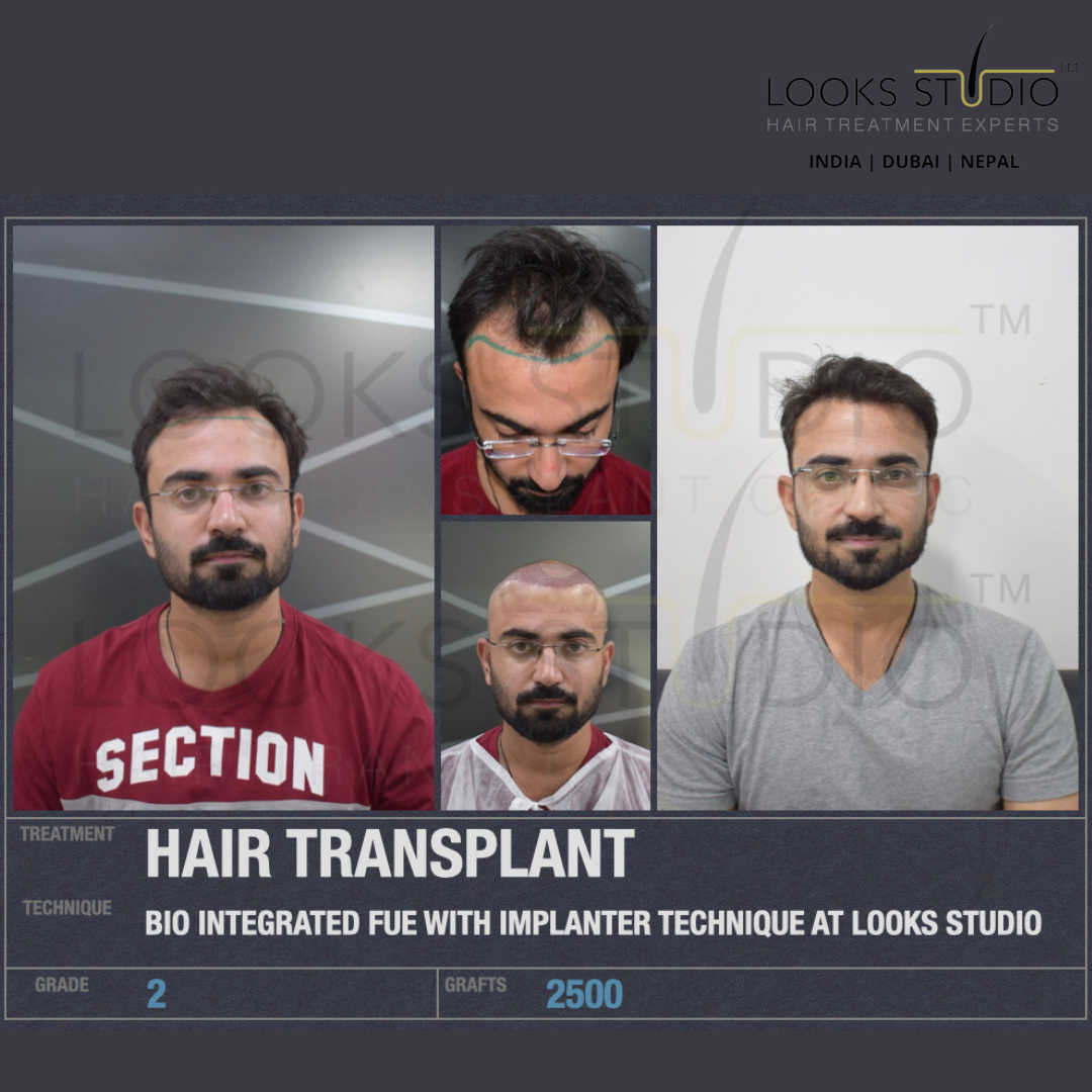 Best Hair Transplant In Surat ✓ Affordable Hair Transplant Cost In Surat -  Amish Hospital
