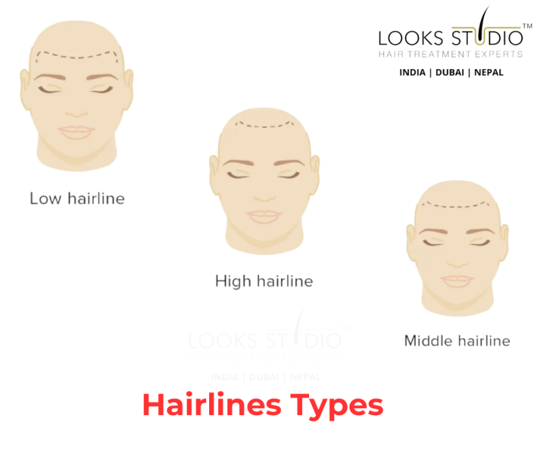 Discover the Different Hairlines Types and How to Achieve Your Desired ...