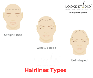 Discover the Different Hairlines Types and How to Achieve Your Desired ...