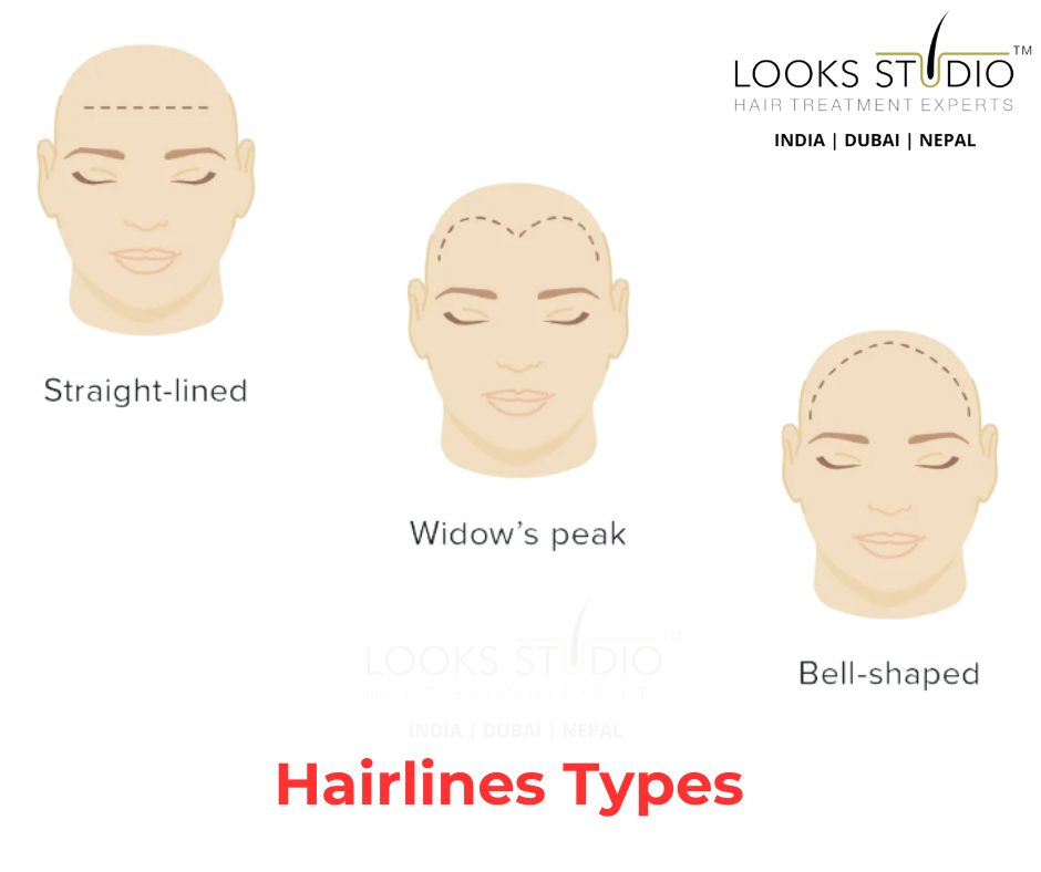 Hairline Types