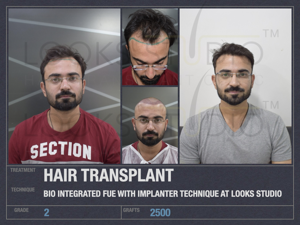 Price of Hair Transplant