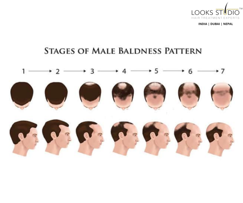 Stages of Baldness