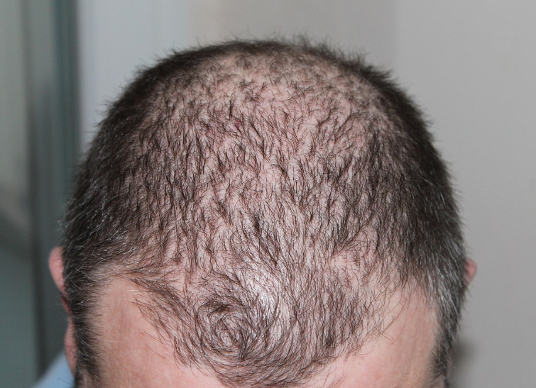 Hair Transplant in Ahmedabad: A Comprehensive Guide to Restoring Your Hair