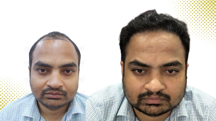 Best hair transplant clinic in Ahmedabad