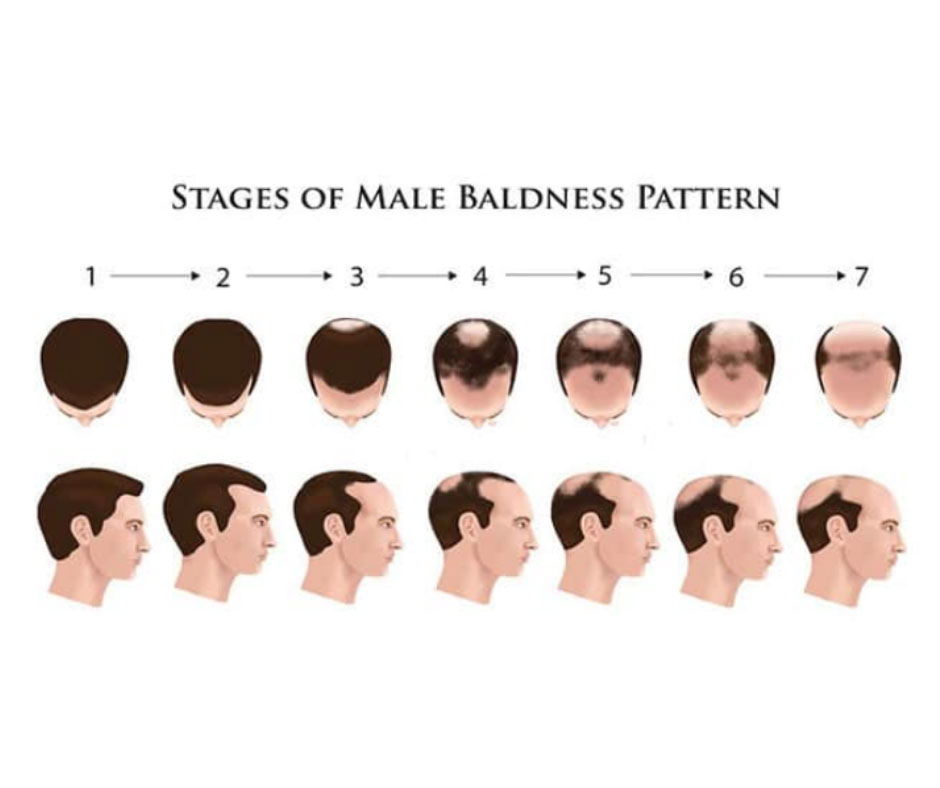 Understanding the Stages of Baldness: A Comprehensive Guide