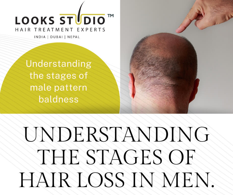 Stages Of Hair Loss: At What Point Should You Consider Hair Transplant For Your Hair Loss?