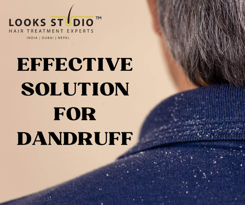 Effective Solution for Dandruff