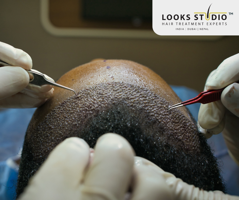 Hair Transplant Cost