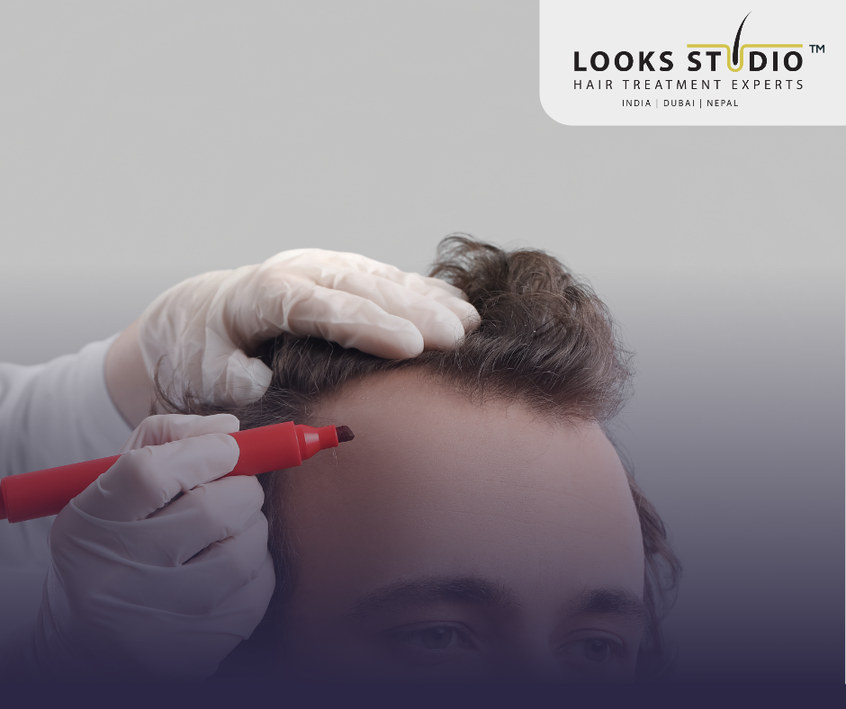 hairline transplant procedure