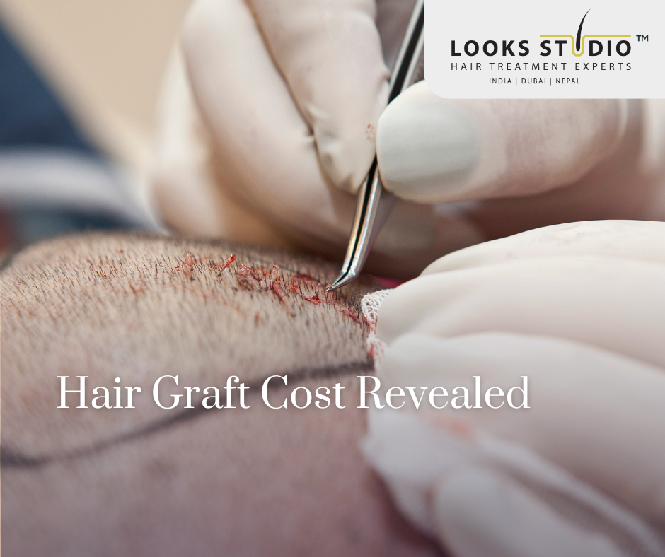 Hair Graft Cost Revealed: The Guide to Affordable Hair Restoration at Looks Studio