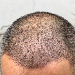 Bio-Integrated FUE