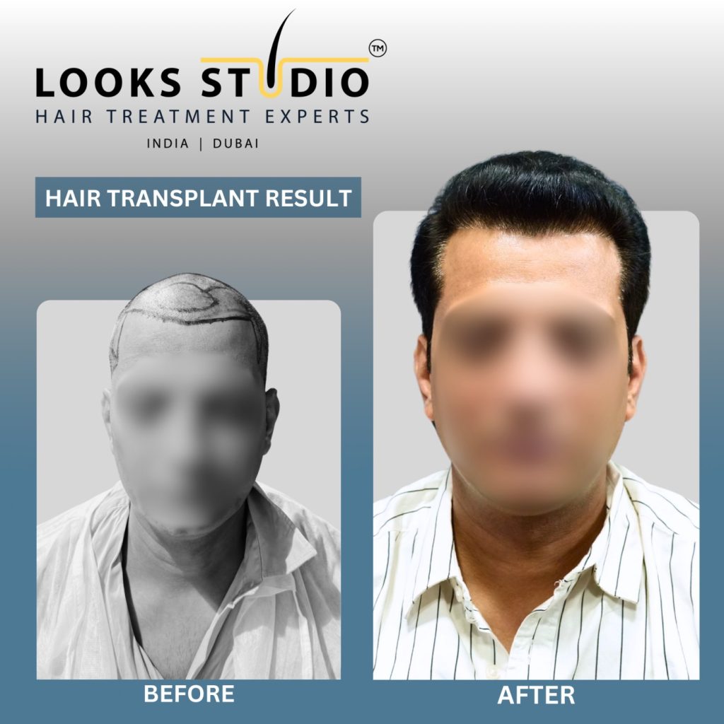 Hair Transplant images before and after Looks Studio