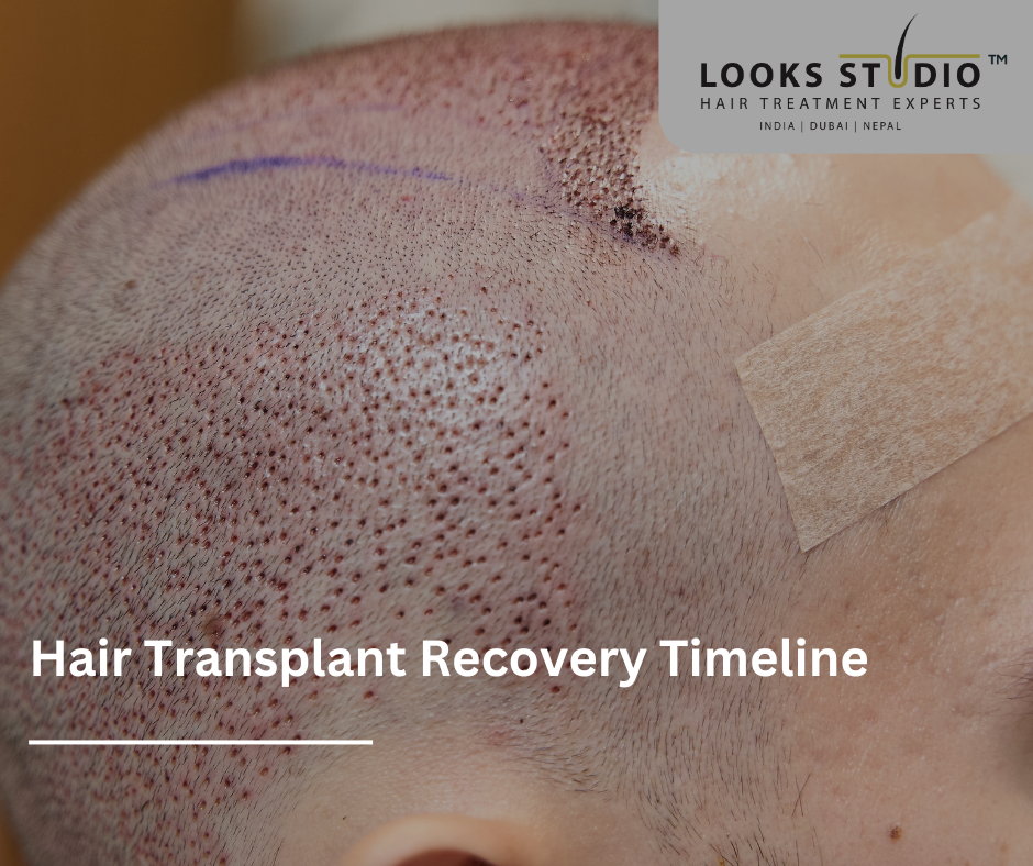 Week-by-Week: Your Hair Transplant Recovery Timeline