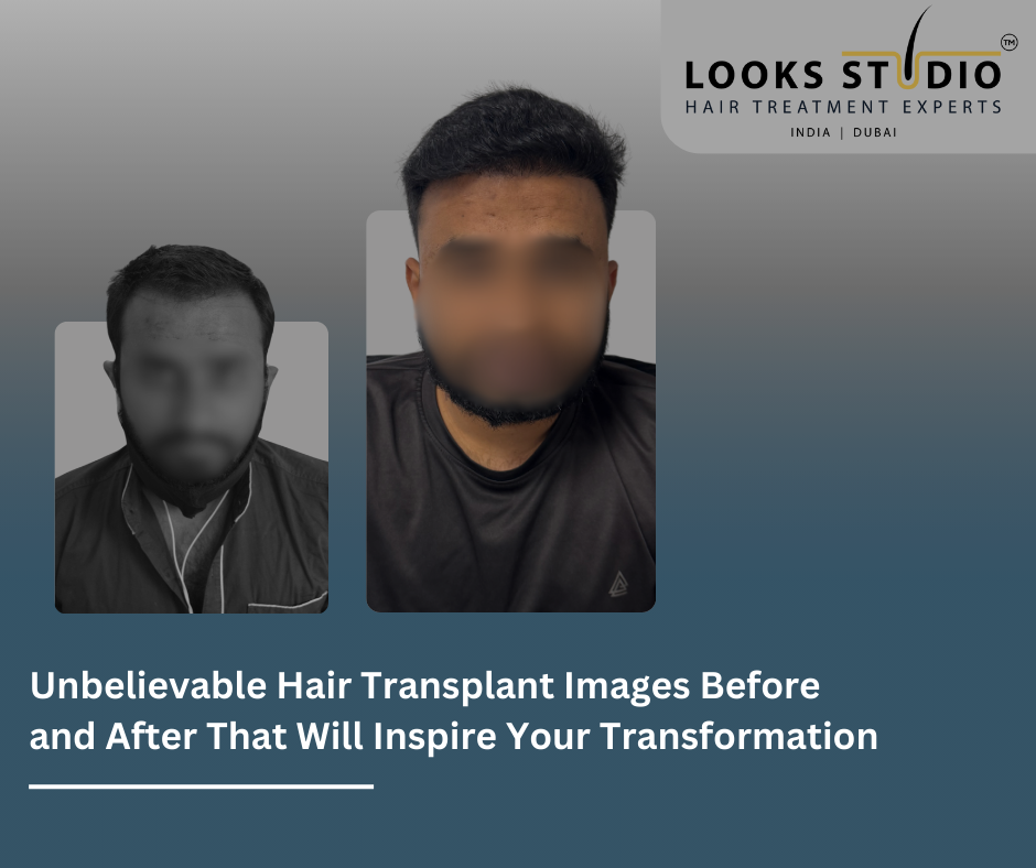 Crowning Glory Restored: Unbelievable Hair Transplant Images Before and After That Will Inspire Your Transformation