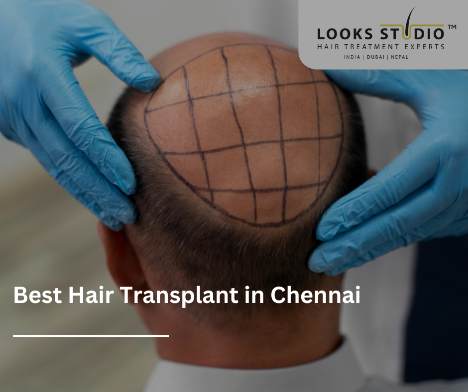 Best Hair Transplant in Chennai | Looks Studio