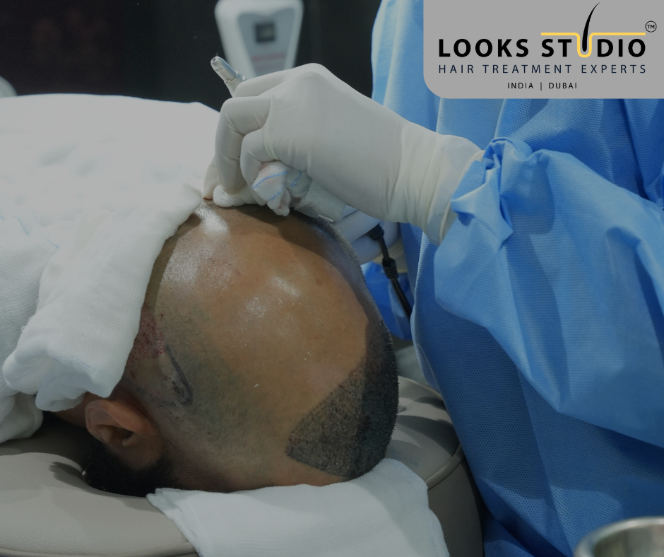 Hair Transplant Clinic in Vijayawada