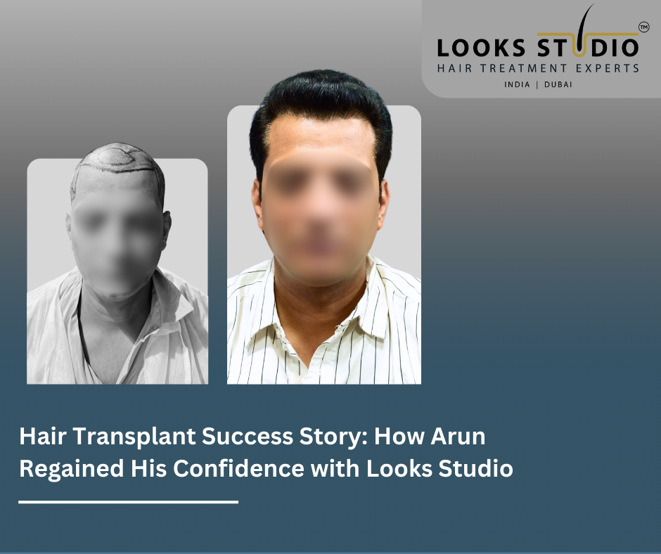 Hair Transplant Success Story: How Arun Regained His Confidence with Looks Studio