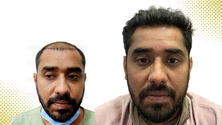 Looks Studio Hair Transplant Results